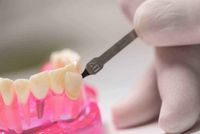 Zahnsanierung für höchste Ansprüche mit Kronen und Inlays